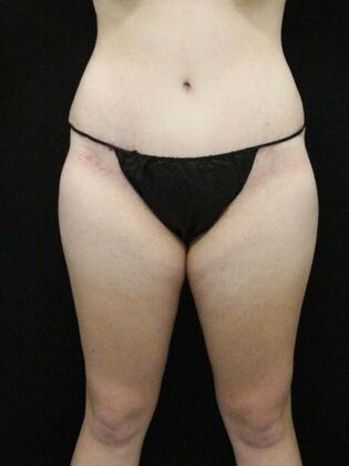Tummy Tuck Case 79 - After