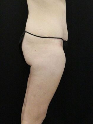 Tummy Tuck: Case 79 - After