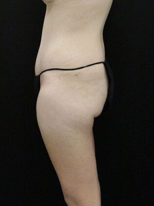 Tummy Tuck: Case 79 - After