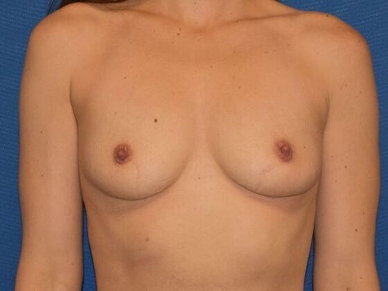 Breast Augmentation Case 6 - Before