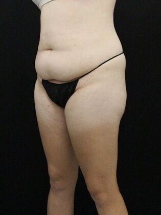 Liposuction: Case 38 - Before