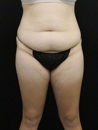Liposuction Case 38 - Before