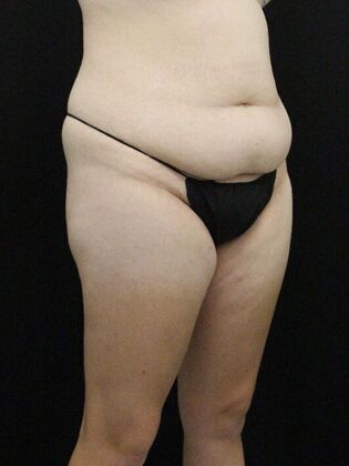 Liposuction: Case 38 - Before