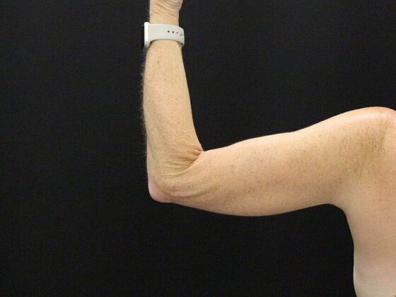 Liposuction: Case 39 - Before