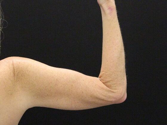 Liposuction Case 39 - Before