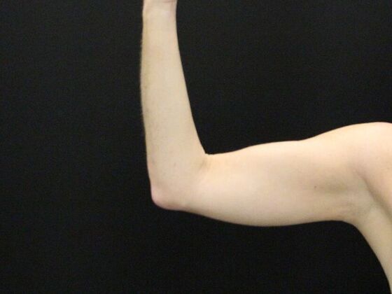 Liposuction: Case 39 - Before