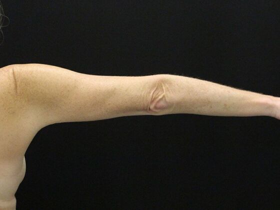 Liposuction: Case 39 - Before