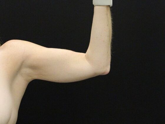 Liposuction: Case 39 - Before