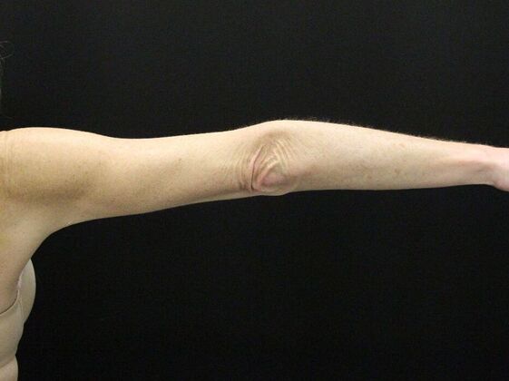 Liposuction: Case 39 - After