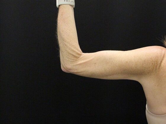 Liposuction: Case 39 - After