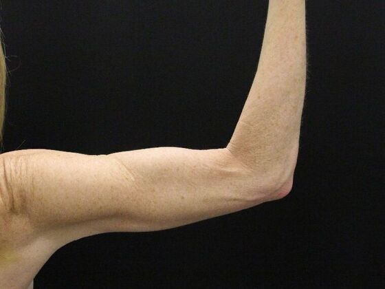 Liposuction Case 39 - After