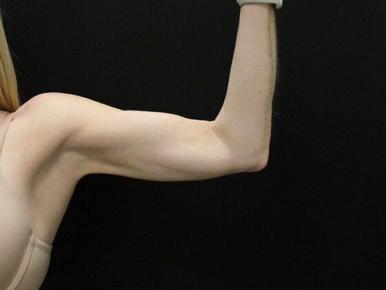 Liposuction: Case 39 - After