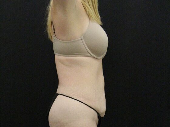 Tummy Tuck: Case 80 - Before