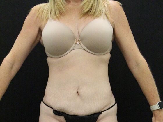 Tummy Tuck: Case 80 - Before