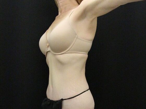 Tummy Tuck Case 80 - After