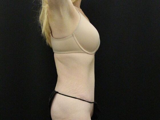 Tummy Tuck: Case 80 - After