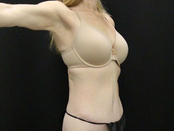 Tummy Tuck: Case 80 - After