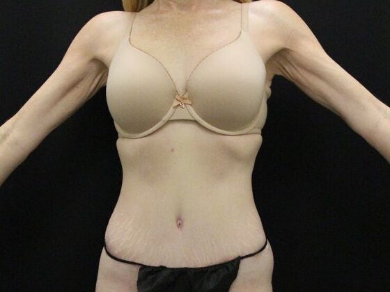 Tummy Tuck: Case 80 - After