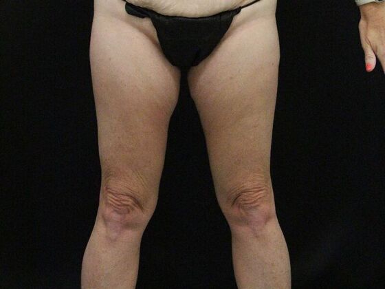 Thigh Lift Case 10 - Before