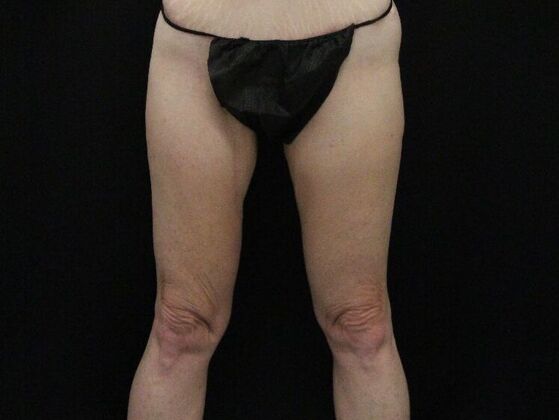 Thigh Lift Case 10 - After