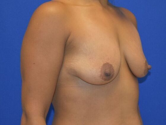 Breast Augmentation: Case 7 - Before