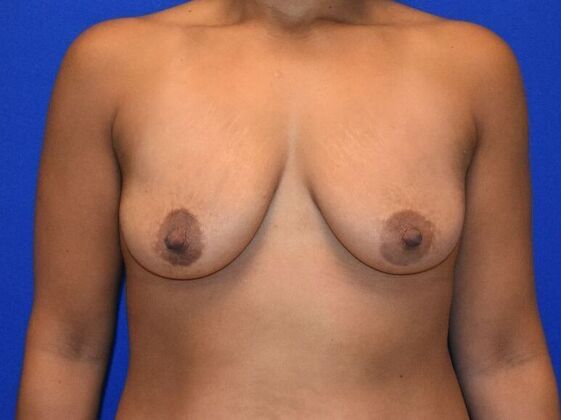 Breast Augmentation Case 7 - Before