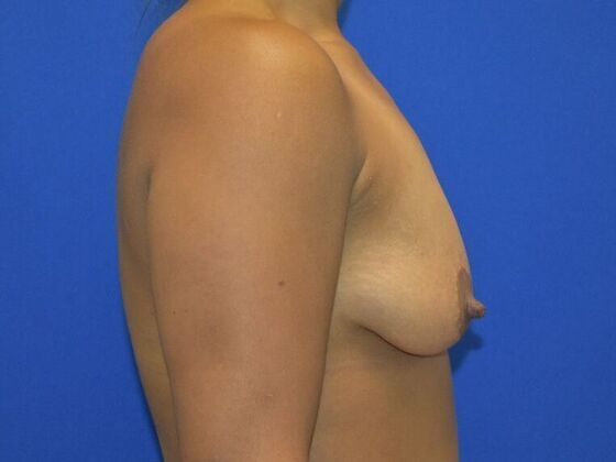 Breast Augmentation: Case 7 - Before