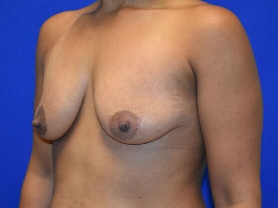 Breast Augmentation: Case 7 - Before
