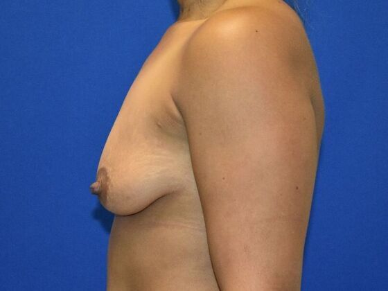 Breast Augmentation: Case 7 - Before