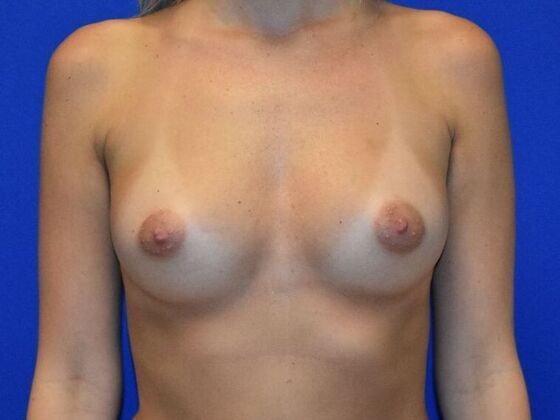 Breast Augmentation Case 8 - Before