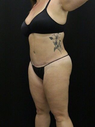 Non-Surgical: Case 14 - Before