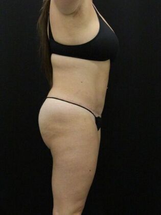 Non-Surgical: Case 14 - Before