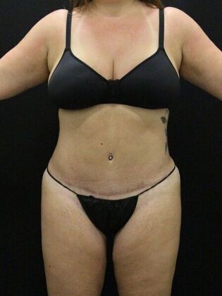 Non-Surgical: Case 14 - Before