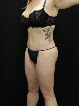 Non-Surgical: Case 14 - After