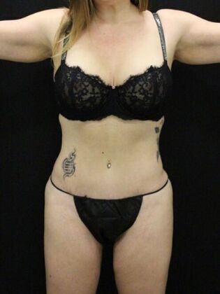 Non-Surgical: Case 14 - After