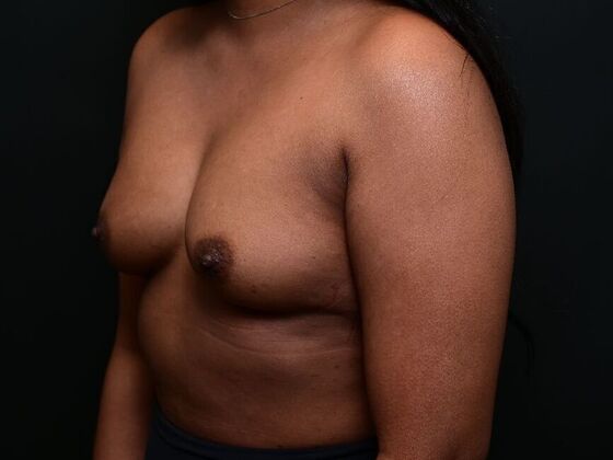 Breast Augmentation: Case 9 - Before