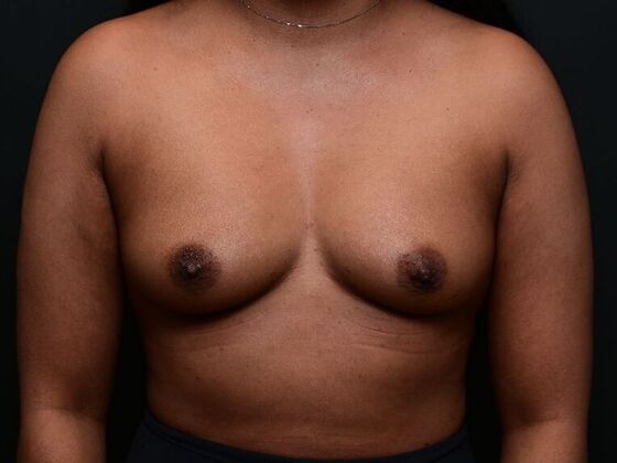 Breast Augmentation Case 9 - Before