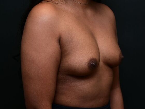 Breast Augmentation: Case 9 - Before