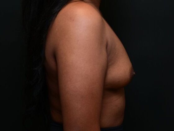 Breast Augmentation: Case 9 - Before