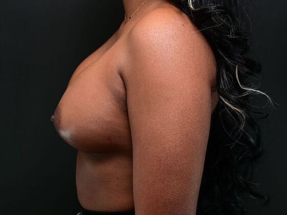 Breast Augmentation: Case 9 - After