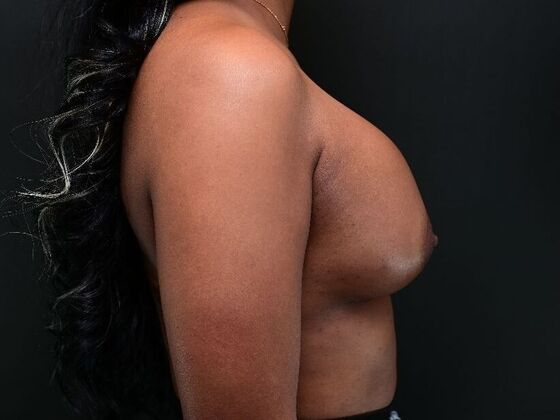 Breast Augmentation: Case 9 - After