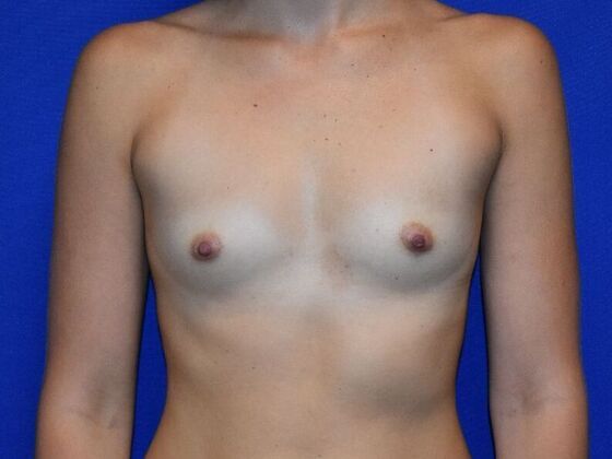 Breast Augmentation Case 10 - Before