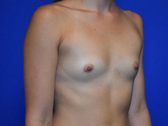 Breast Augmentation: Case 10 - Before