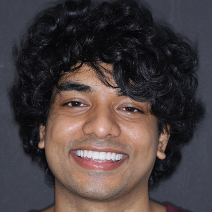 No Prep Porcelain Veneers Sakib - After