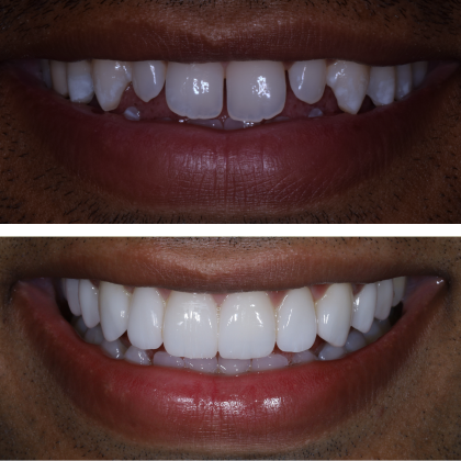 No Prep Porcelain Veneers Sakib - Before