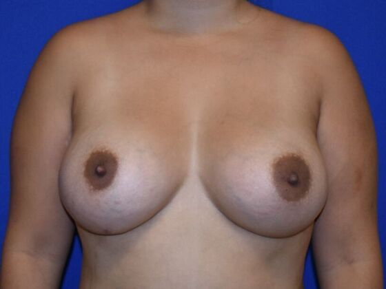 Breast Augmentation Case 11 - After