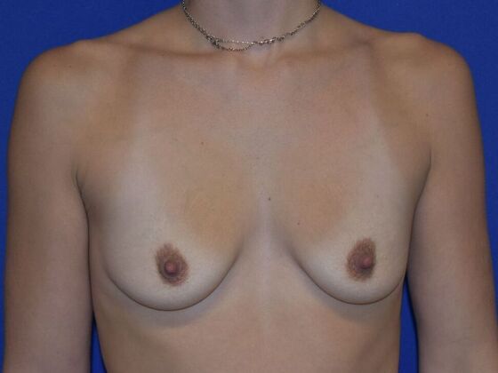 Breast Augmentation Case 12 - Before