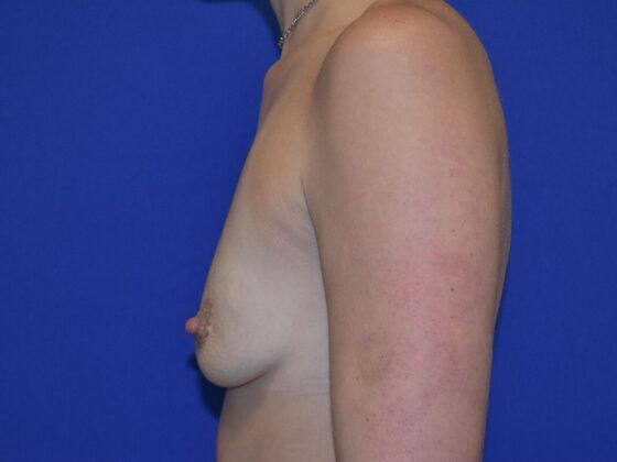 Breast Augmentation: Case 12 - Before