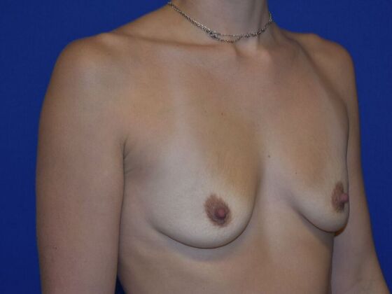 Breast Augmentation: Case 12 - Before