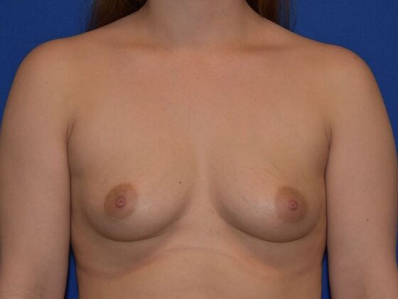 Breast Augmentation Case 13 - Before